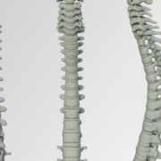 images of the spine, suggesting how flatback syndrome affects the body.