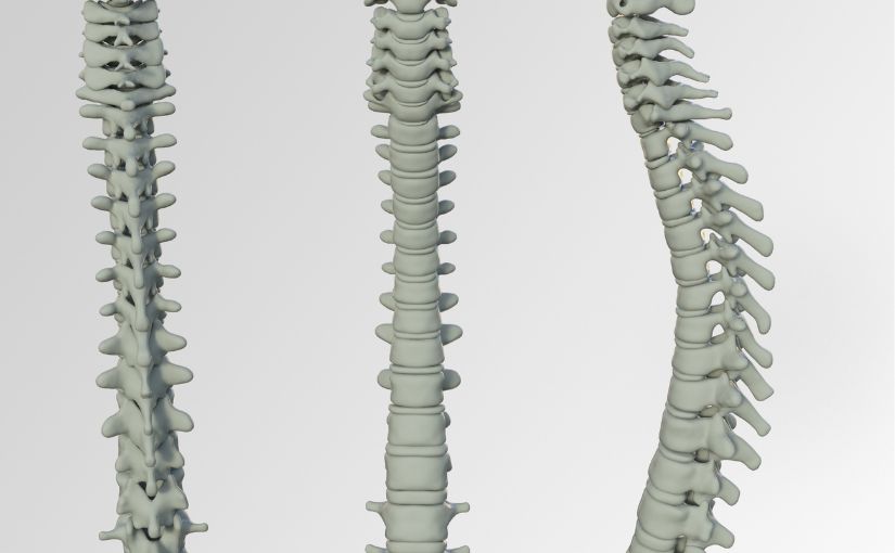 images of the spine, suggesting how flatback syndrome affects the body.